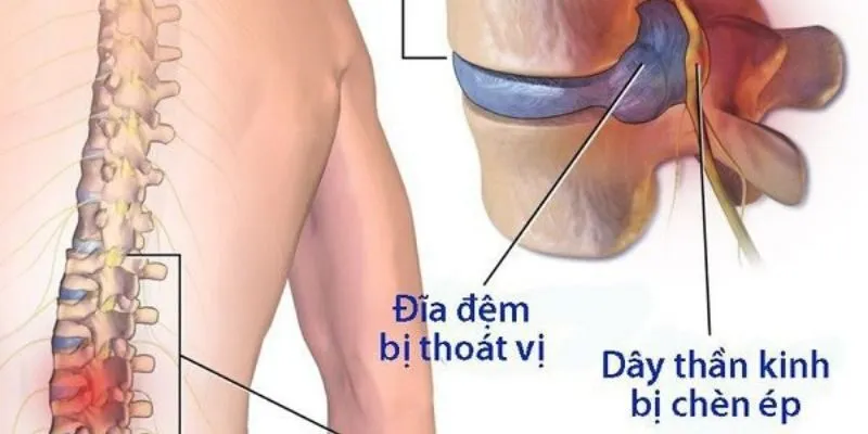 Thoát vị đĩa đệm