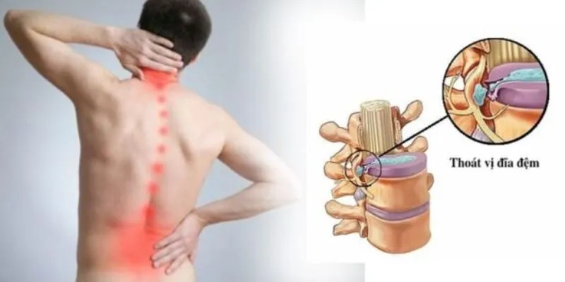 Thoát vị đĩa đệm cột sống
