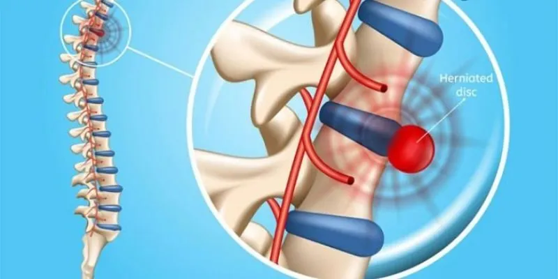 Gai đôi cột sống