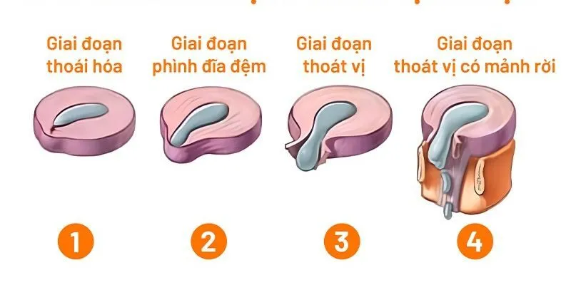thoát vị đĩa đệm thắt lưng
