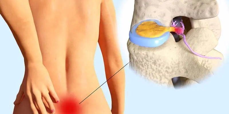 điều trị thoát vị đĩa đệm