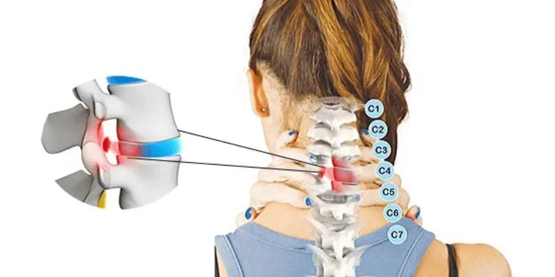 Đĩa Đệm: Vai Trò Quan Trọng và Cách Bảo Vệ Cột Sống