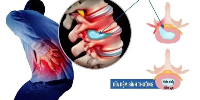 thoát vị đĩa đệm thắt lưng