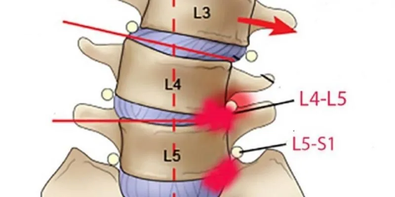 Thoát vị đĩa đệm cột sống thắt lưng l4 l5